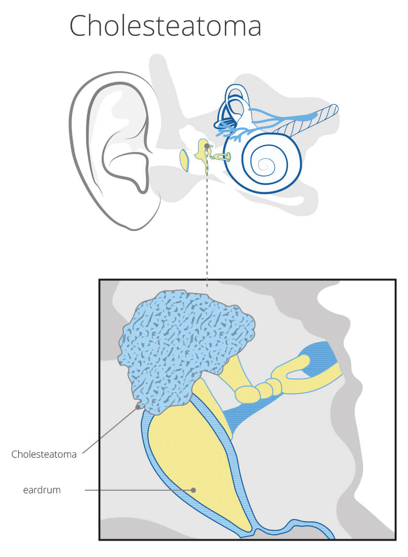 Cholesteatoma detailed diagram