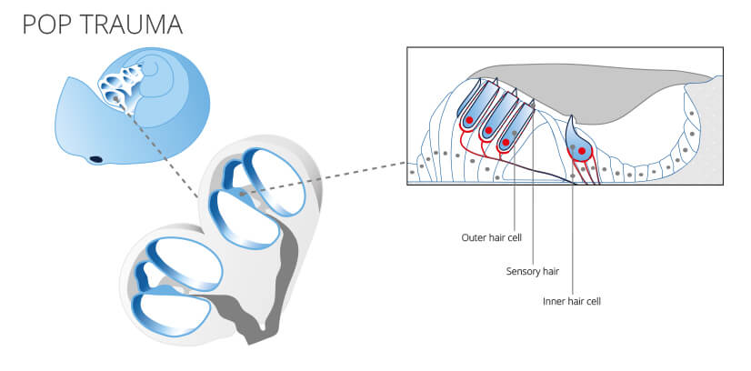 pop trauma detailed diagram