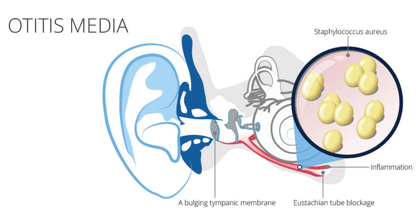 otitis media detailed diagram